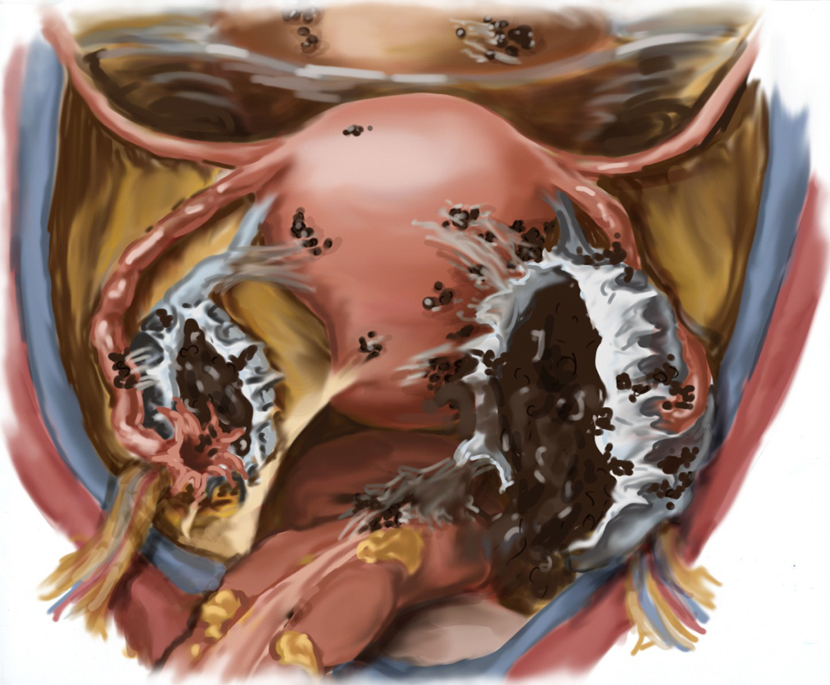 Endometriosis intestinal sintomas